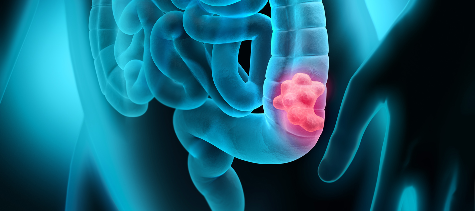 Body,With,Intestinal,Polyp,-,3d,Illustration